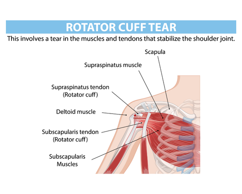 labelled anatomical diagram of a torn rotator cuff